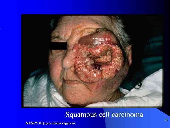 Squamous cell carcinoma МГМСУ Кафедра общей хирургии 52 