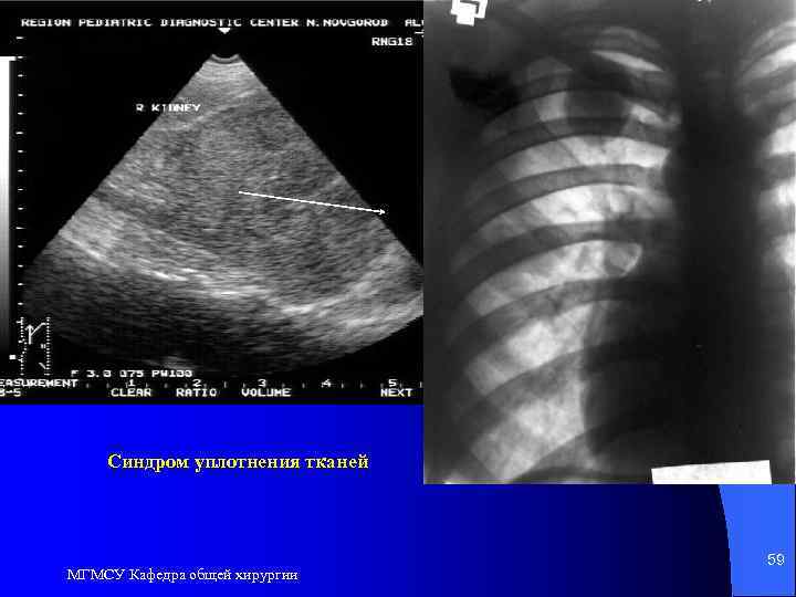 Синдром уплотнения тканей МГМСУ Кафедра общей хирургии 59 