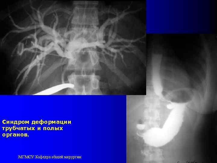 Синдром деформации трубчатых и полых органов. МГМСУ Кафедра общей хирургии 60 
