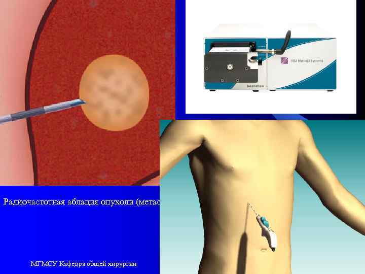 Радиочастотная аблация опухоли (метастаза) МГМСУ Кафедра общей хирургии 84 