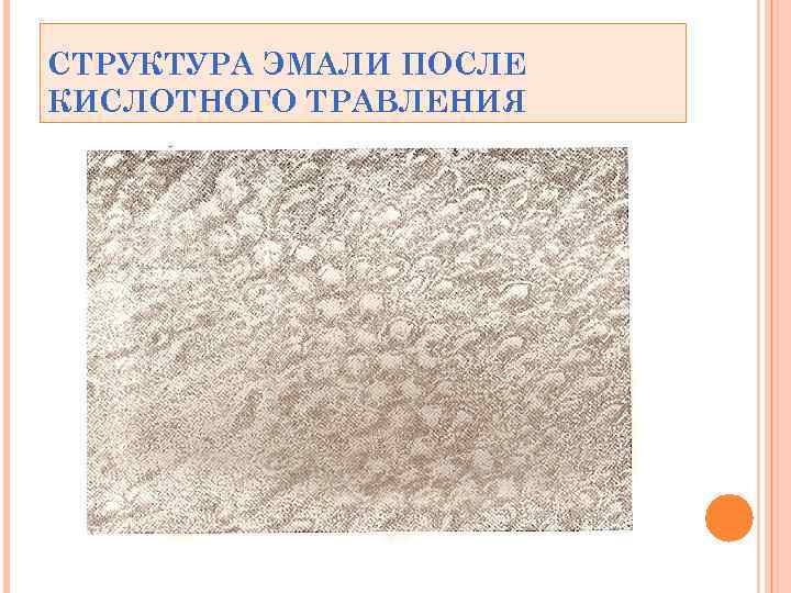 СТРУКТУРА ЭМАЛИ ПОСЛЕ КИСЛОТНОГО ТРАВЛЕНИЯ 