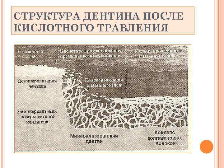 СТРУКТУРА ДЕНТИНА ПОСЛЕ КИСЛОТНОГО ТРАВЛЕНИЯ 