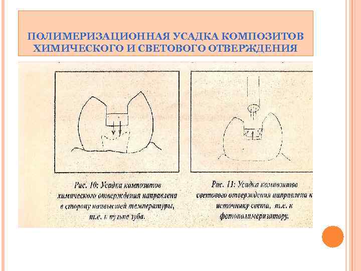 ПОЛИМЕРИЗАЦИОННАЯ УСАДКА КОМПОЗИТОВ ХИМИЧЕСКОГО И СВЕТОВОГО ОТВЕРЖДЕНИЯ 