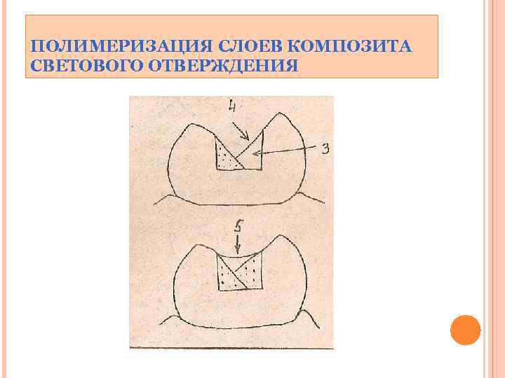 ПОЛИМЕРИЗАЦИЯ СЛОЕВ КОМПОЗИТА СВЕТОВОГО ОТВЕРЖДЕНИЯ 