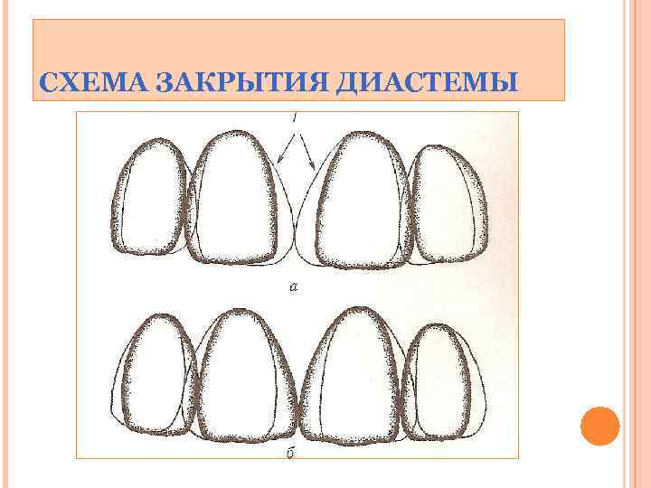 СХЕМА ЗАКРЫТИЯ ДИАСТЕМЫ 