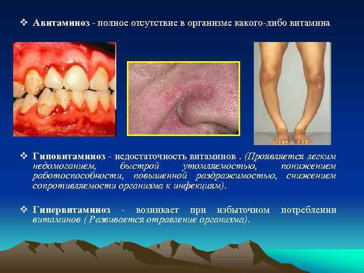 v Авитаминоз - полное отсутствие в организме какого-либо витамина v Гиповитаминоз - недостаточность витаминов.