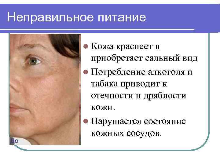 Неправильное питание l Кожа краснеет и приобретает сальный вид l Потребление алкоголя и табака