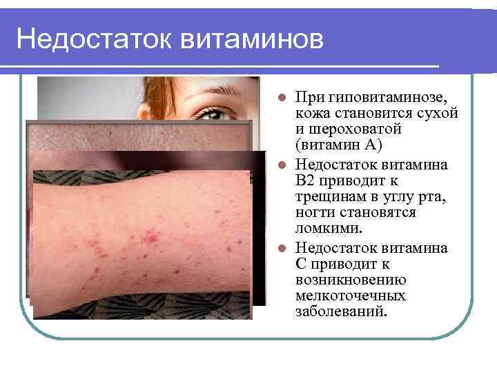 Недостаток витаминов При гиповитаминозе, кожа становится сухой и шероховатой (витамин А) l Недостаток витамина
