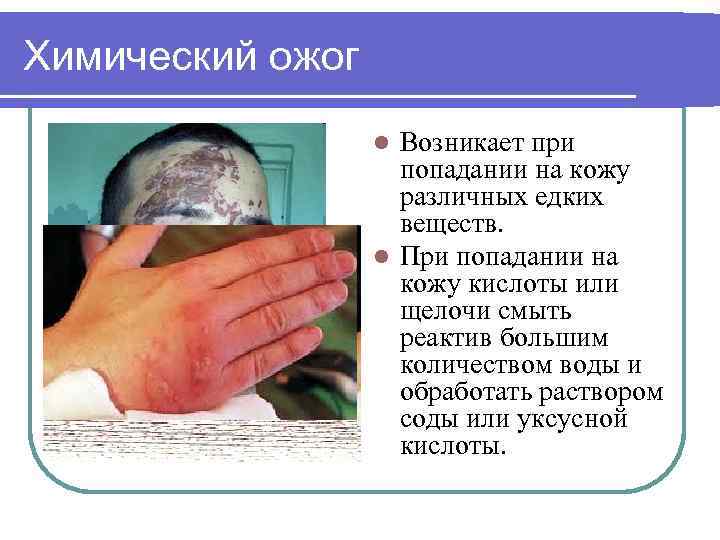 Химический ожог Возникает при попадании на кожу различных едких веществ. l При попадании на