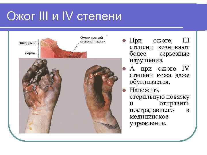 Ожог III и IV степени При ожоге III степени возникают более серьезные нарушения. l