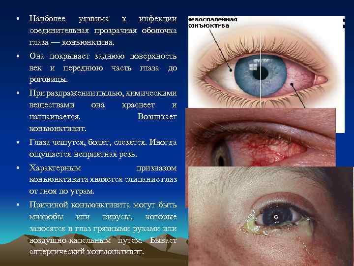  • Наиболее уязвима к инфекции соединительная прозрачная оболочка глаза — конъюнктива. • Она