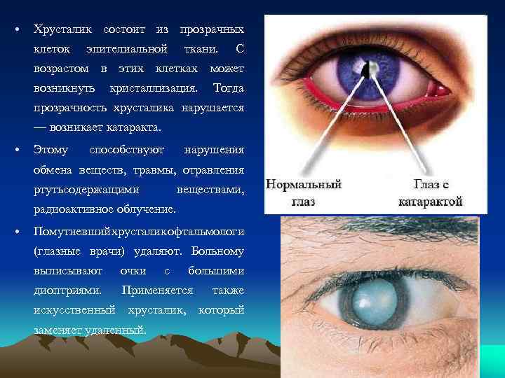  • Хрусталик состоит из прозрачных клеток эпителиальной ткани. С возрастом в этих клетках