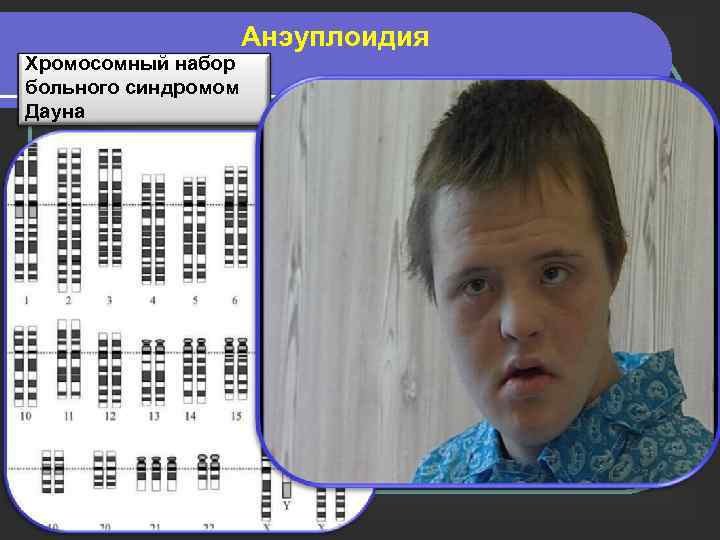 Хромосомный набор больного синдромом Дауна Анэуплоидия 