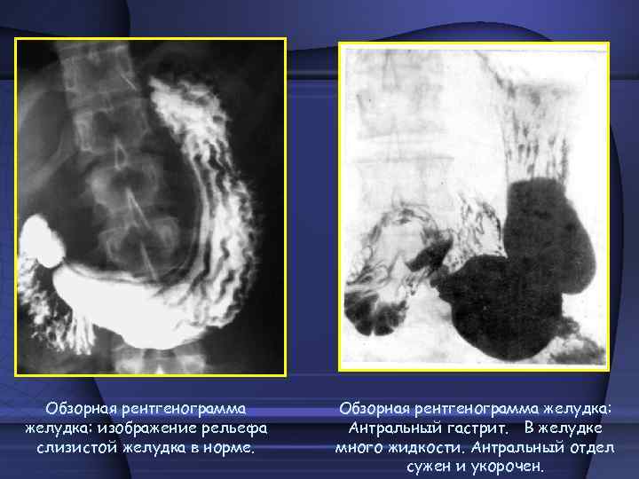 Рентгенография желудка презентация