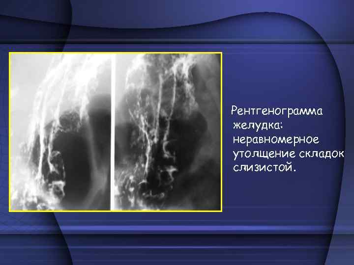 Рентгенограмма желудка: неравномерное утолщение складок слизистой. 