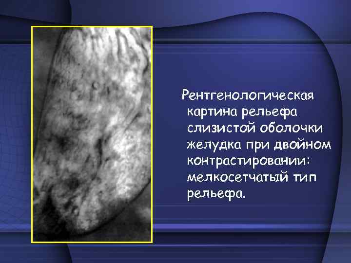 Рентгенологическая картина рельефа слизистой оболочки желудка при двойном контрастировании: мелкосетчатый тип рельефа. 