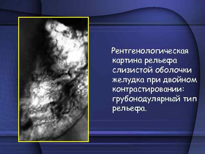 Рентгенологическая картина рельефа слизистой оболочки желудка при двойном контрастировании: грубонодулярный тип рельефа. 