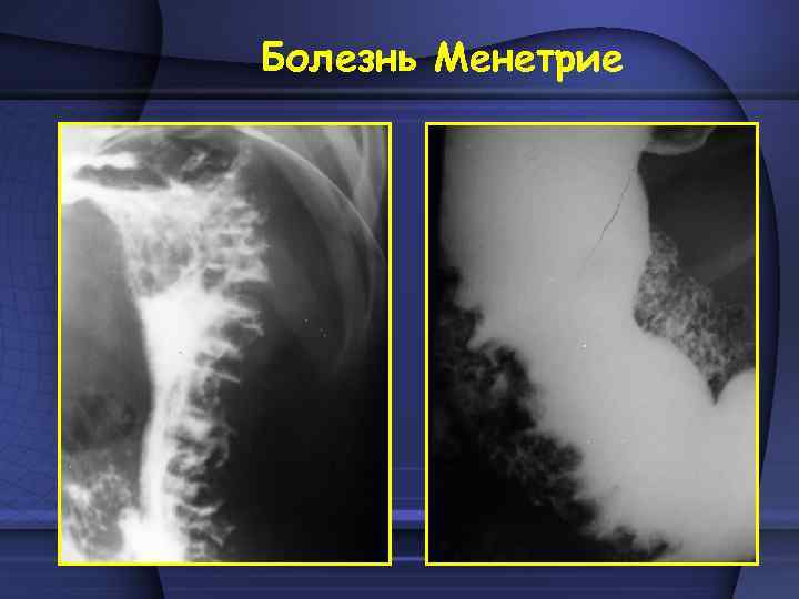 Болезнь Менетрие 