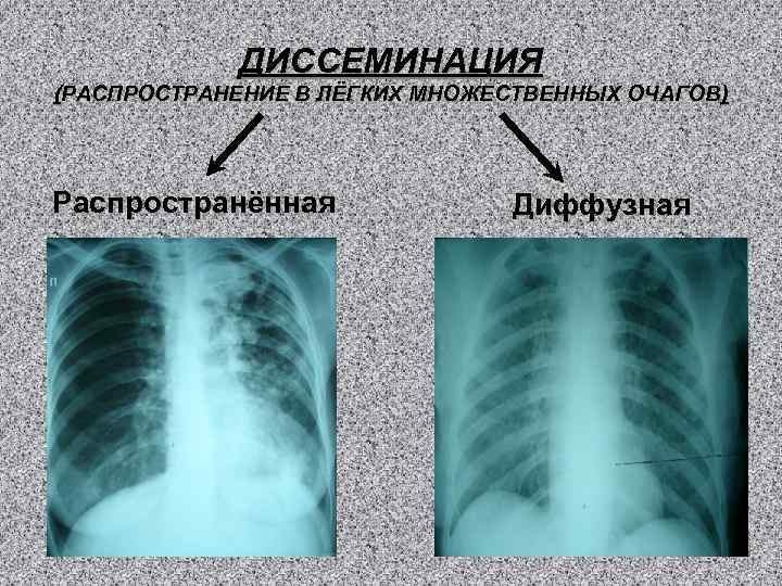 ДИССЕМИНАЦИЯ (РАСПРОСТРАНЕНИЕ В ЛЁГКИХ МНОЖЕСТВЕННЫХ ОЧАГОВ) Распространённая Диффузная 