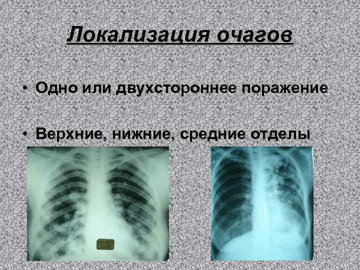Локализация очагов • Одно или двухстороннее поражение • Верхние, нижние, средние отделы 