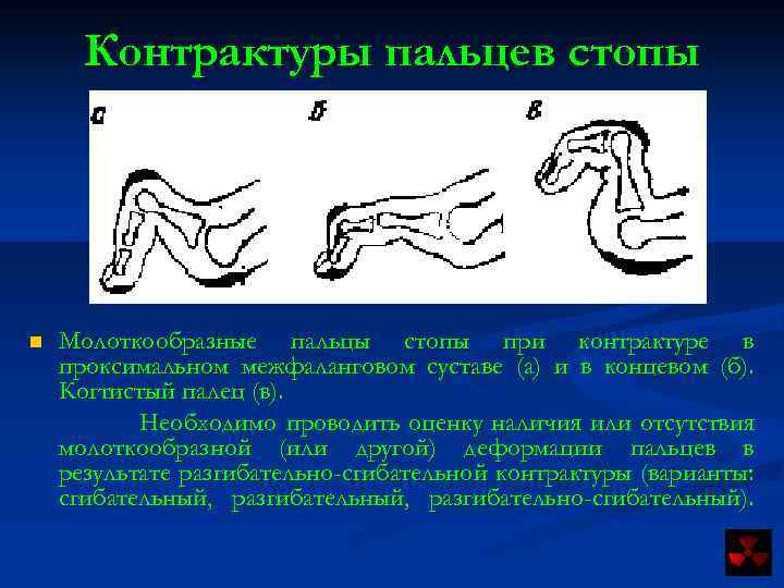Контрактуры пальцев стопы n Молоткообразные пальцы стопы при контрактуре в проксимальном межфаланговом суставе (а)
