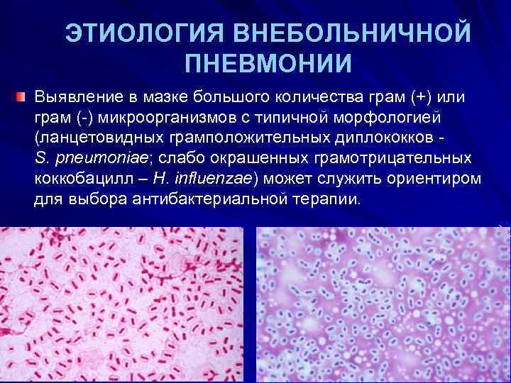 ЭТИОЛОГИЯ ВНЕБОЛЬНИЧНОЙ ПНЕВМОНИИ Выявление в мазке большого количества грам (+) или грам (-) микроорганизмов