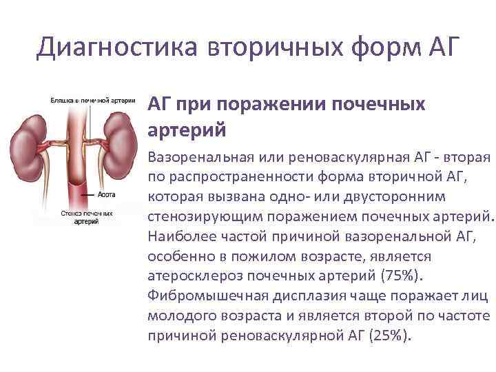Диагностика вторичных форм АГ • АГ при поражении почечных артерий • Вазоренальная или реноваскулярная