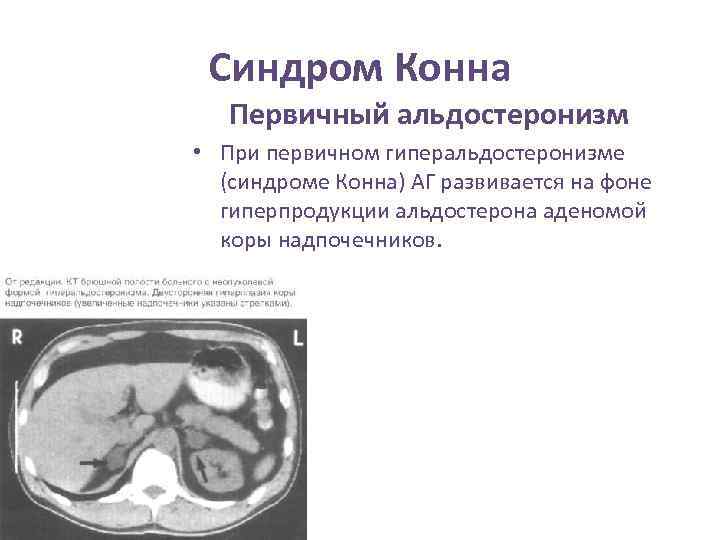 Синдром конна презентация