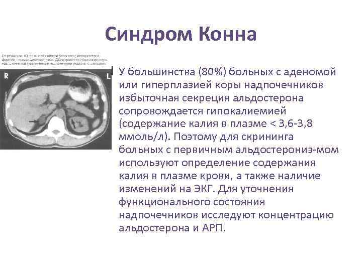 Синдром конна презентация