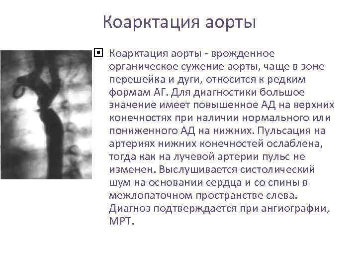 Коарктация аорты - врожденное органическое сужение аорты, чаще в зоне перешейка и дуги, относится