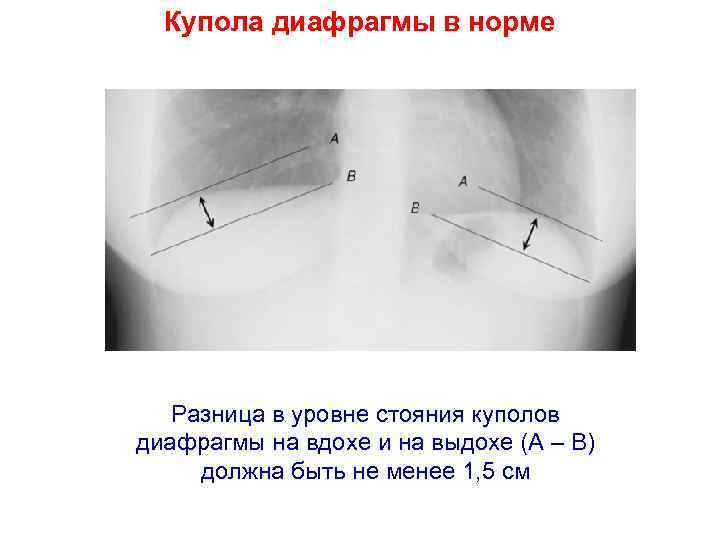 Купола диафрагмы в норме Разница в уровне стояния куполов диафрагмы на вдохе и на