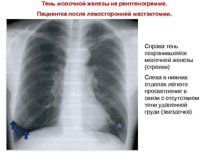 При выпотном перикардите на рентгенограмме наблюдается легочный рисунок тест ответ