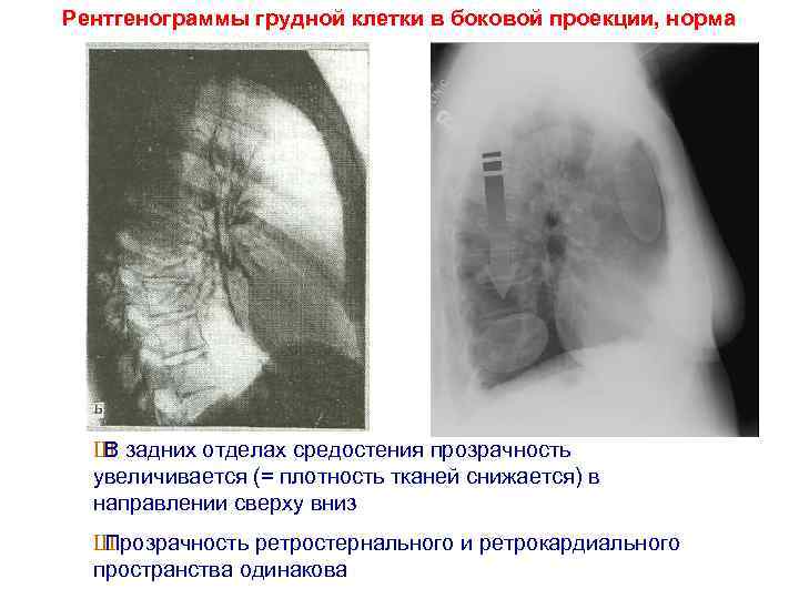 Рентгенограммы грудной клетки в боковой проекции, норма Ш В задних отделах средостения прозрачность увеличивается