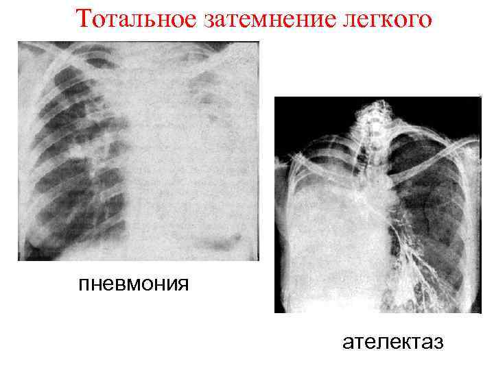 Ателектазы рентген схема