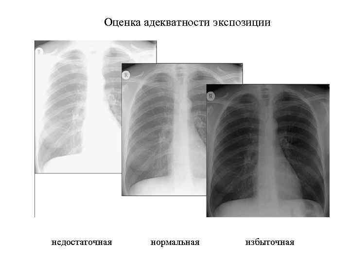 Оценка адекватности экспозиции недостаточная нормальная избыточная 