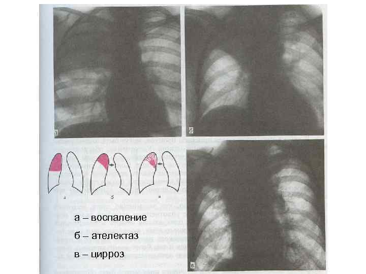 а – воспаление б – ателектаз в – цирроз 