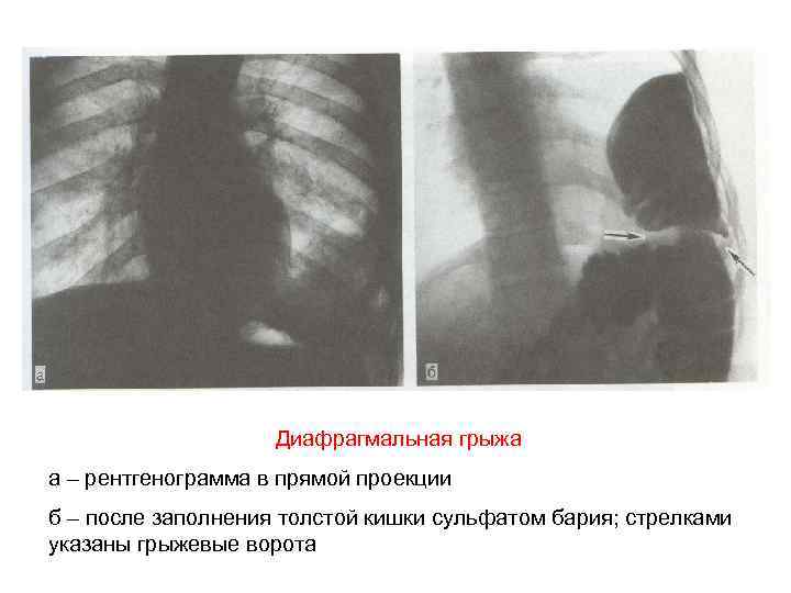 Диафрагмальная грыжа а – рентгенограмма в прямой проекции б – после заполнения толстой кишки