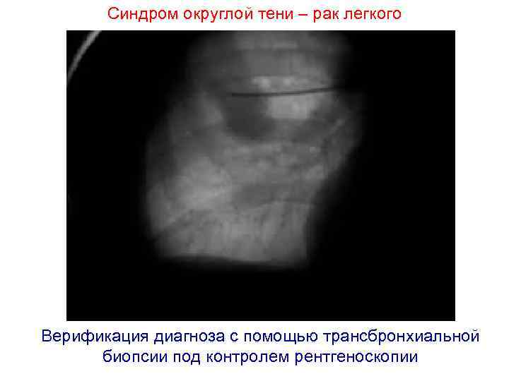 Синдром округлой тени – рак легкого Верификация диагноза с помощью трансбронхиальной биопсии под контролем