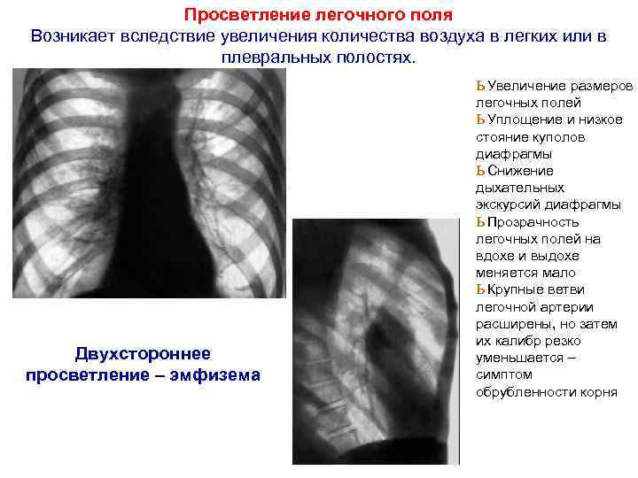 Просветление в легких. Просветление легочного поля. Эмфизематозные поля легких. Обширное просветление легочного поля.