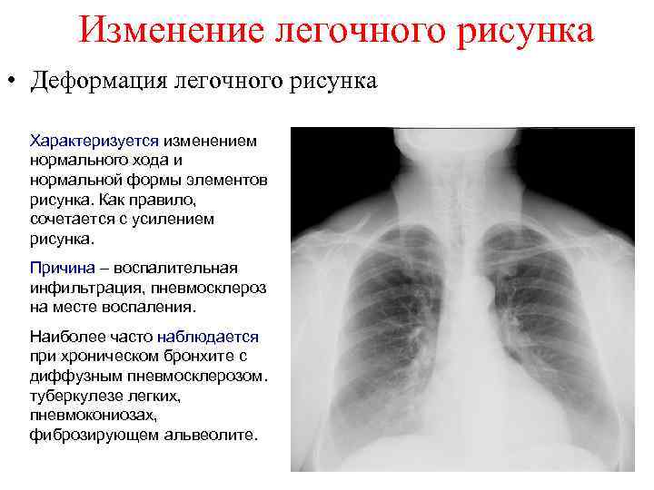 Что значит легочный рисунок усилен в нижних отделах