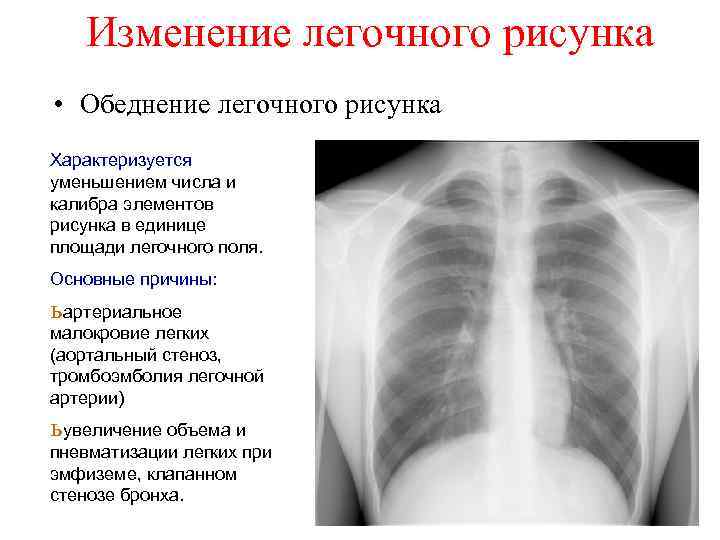 Усиление легочного рисунка на рентгене у ребенка