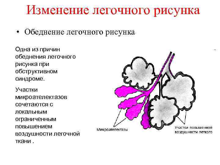 Легочный рисунок деформирован в медиальных зонах что это