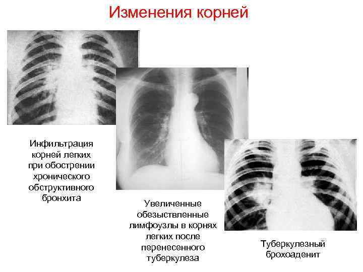 Изменения легочного и корневого рисунка