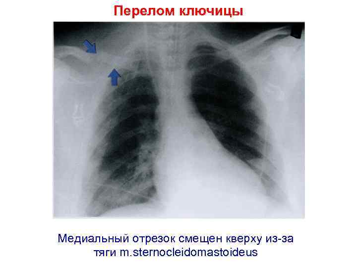 Перелом ключицы Медиальный отрезок смещен кверху из-за тяги m. sternocleidomastoideus 
