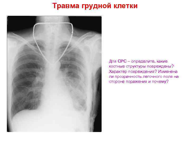 Ушиб грудной клетки. Закрытая травма грудной клетки. Ушиб левой половины грудной клетки. Ушиб грудной клетки осложнения.