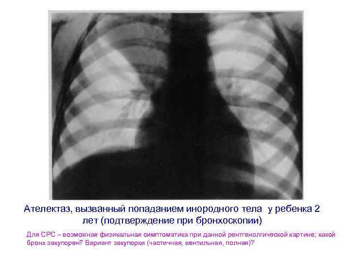 Ателектаз, вызванный попаданием инородного тела у ребенка 2 лет (подтверждение при бронхоскопии) Для СРС