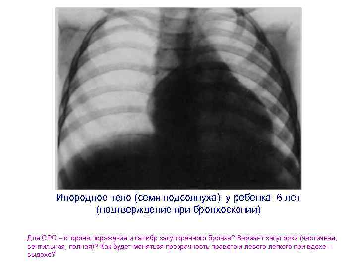 Инородное тело (семя подсолнуха) у ребенка 6 лет (подтверждение при бронхоскопии) Для СРС –