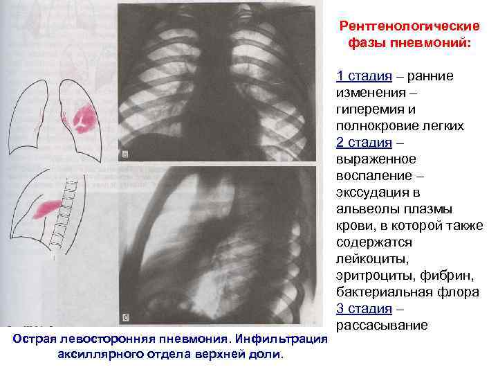 Левосторонняя пневмония