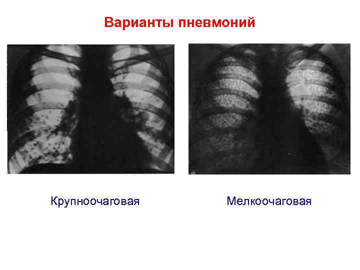 Двухсторонняя пневмония. Двусторонняя мелкоочаговая пневмония рентген. Мелкоочаговая бронхопневмония. Крупноочаговая пневмония рентген. Двухсторонняя очаговая пневмония рентген.