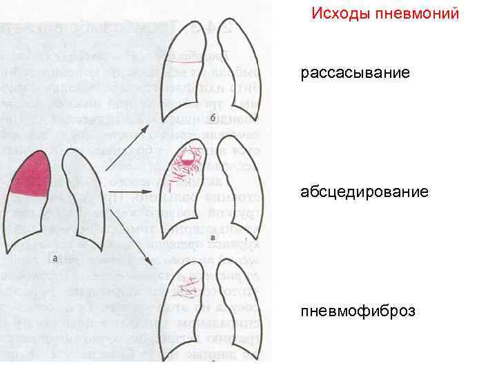 Лечение пневмонии в стационаре схемы